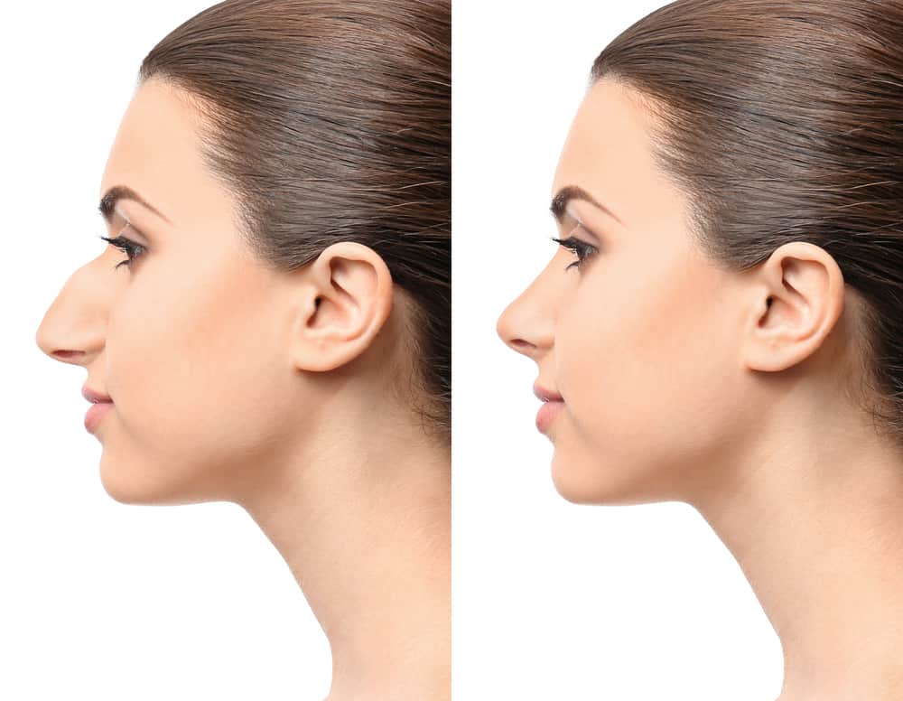 Surgical / Non-Surgical Rhinoplasty